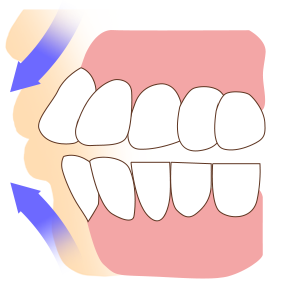 입술돌출 그림